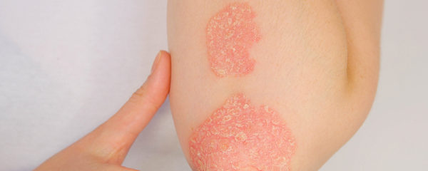 psoriasis