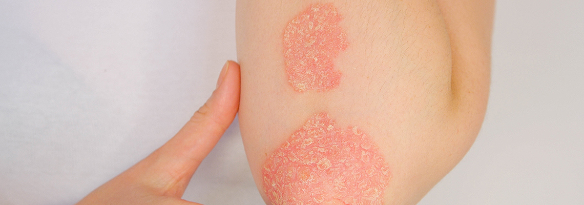 psoriasis